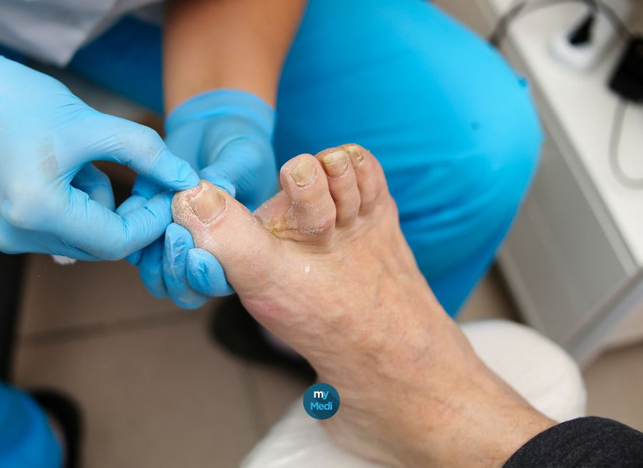 Ongles mycosés : comment ne plus en avoir ?