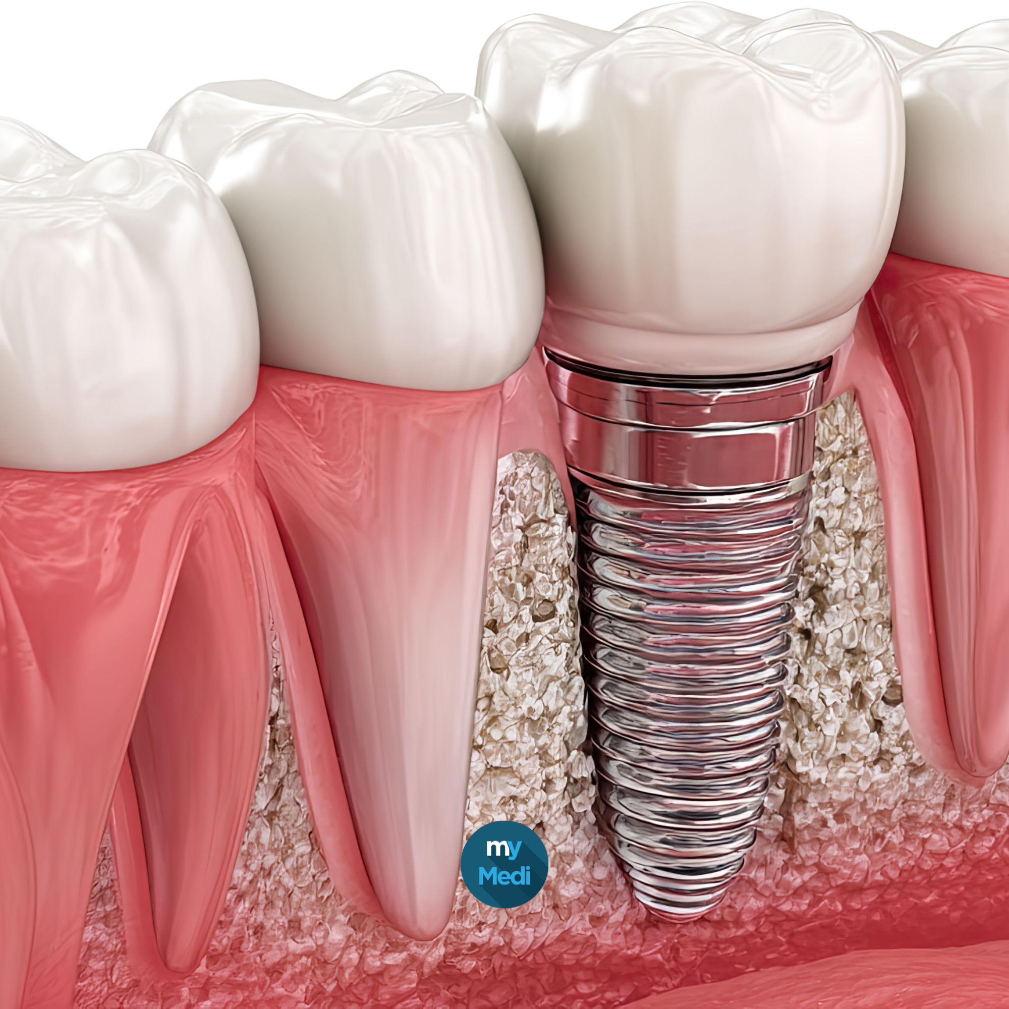 Instruments pour greffe dentaire