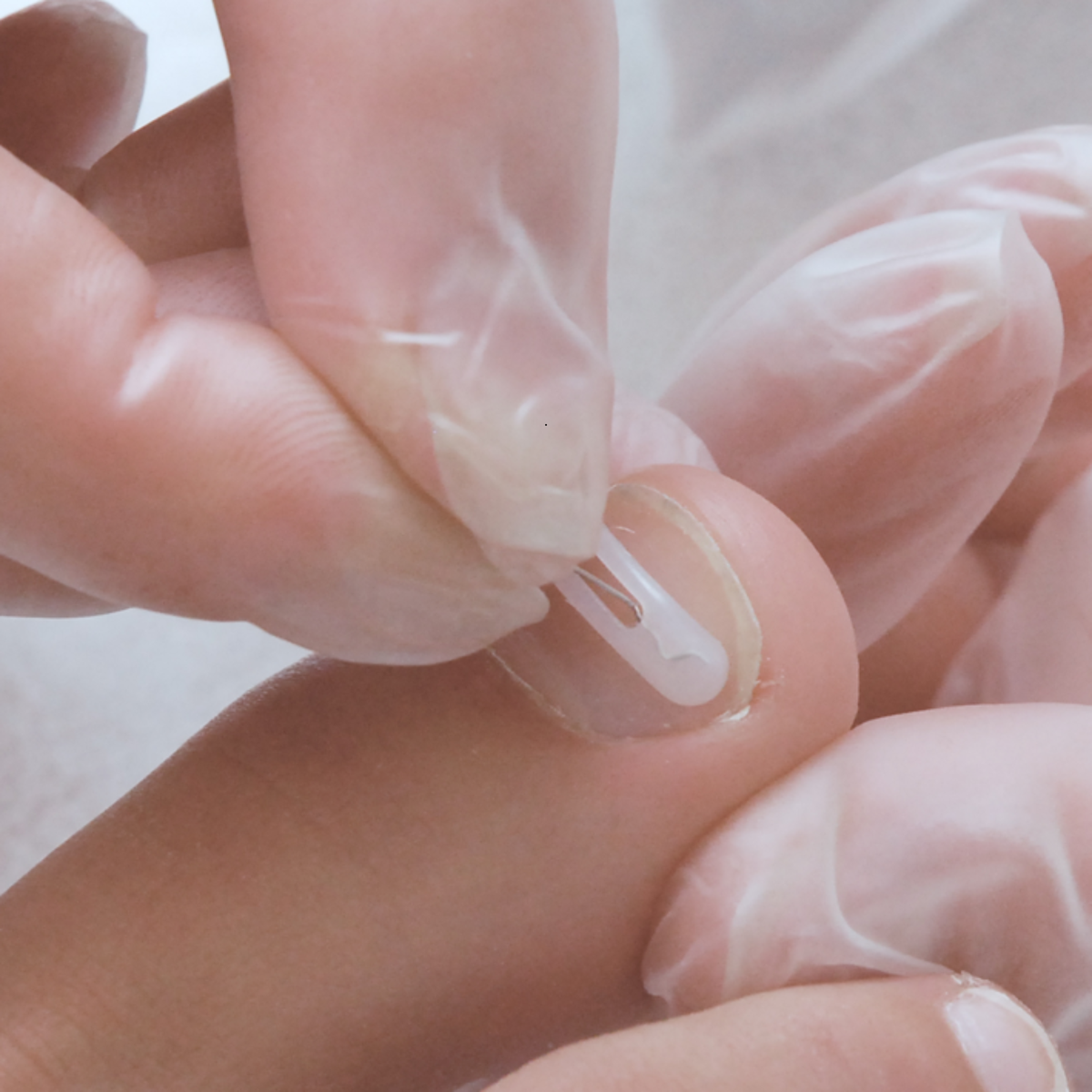 Kit complet d’orthonyxie pour ongles incarnés et déformés – Podofix - My Médical