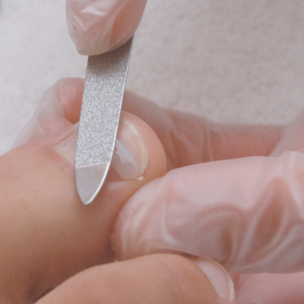 Kit complet d’orthonyxie pour ongles incarnés et déformés – Podofix - My Médical