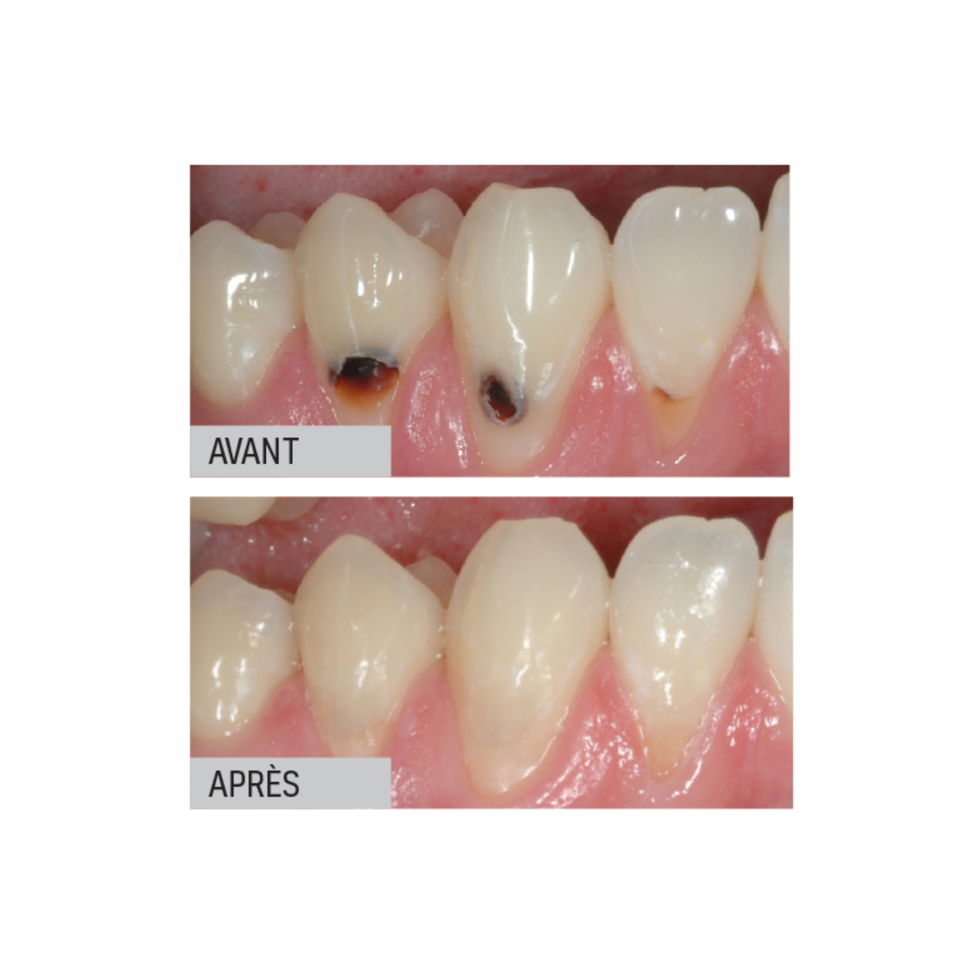 Riva Light Cure HV - Verre ionomère - 50 capsules - plusieurs teintes - SDI