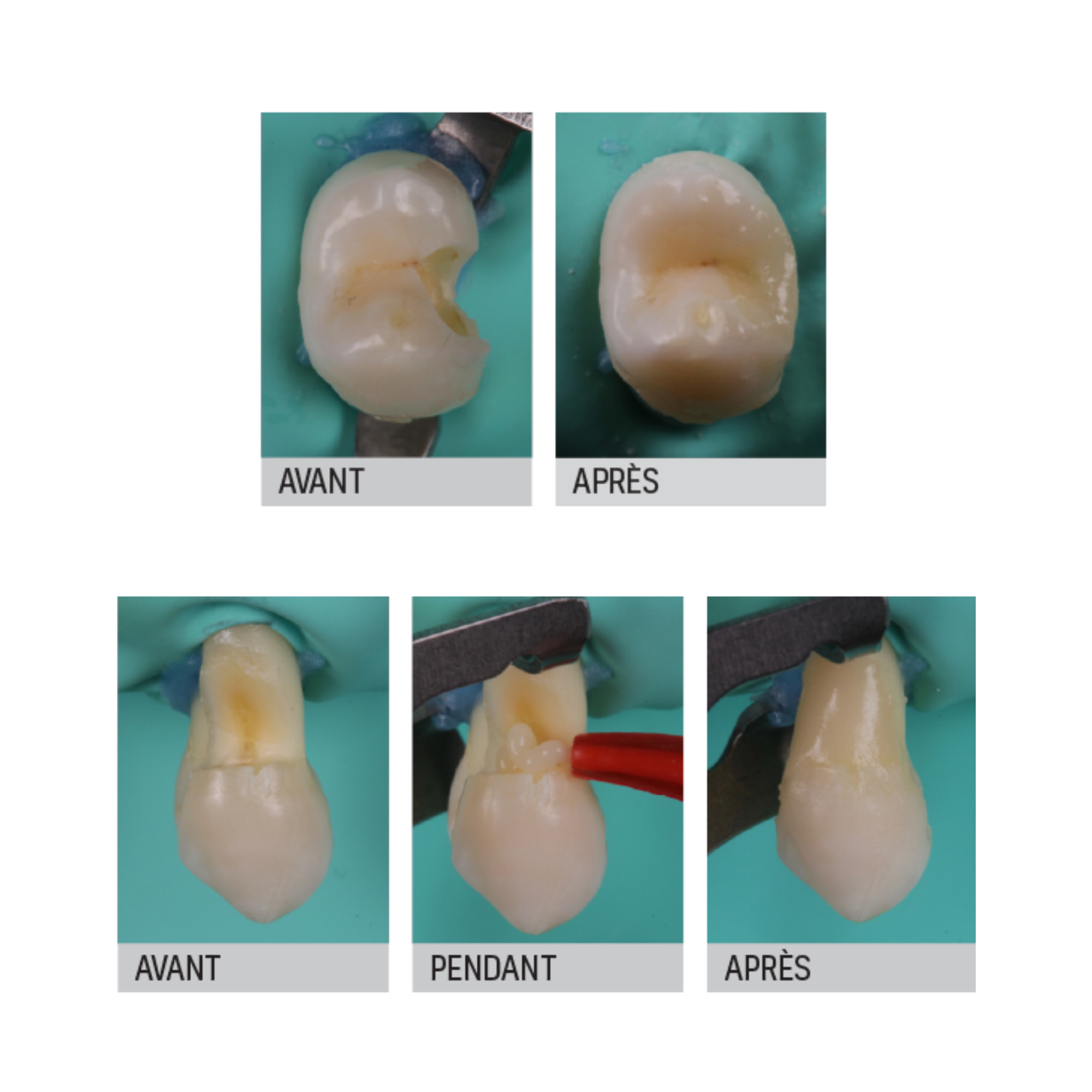 Riva Light Cure HV - Verre ionomère - 50 capsules - plusieurs teintes - SDI